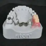 Impresora 3D de metal M-200D 11 Modelo de prótesis dental fija en resina y metal, mostrando estructura metálica y dientes artificiales, utilizado para restaurar la función y estética de la sonrisa.