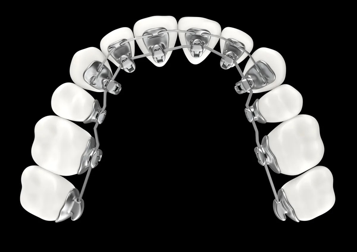 Impresora 3D de metal MLab 4 Imagen de brackets metálicos en dientes superiores, mostrando un tratamiento de ortodoncia para corregir la alineación dental.