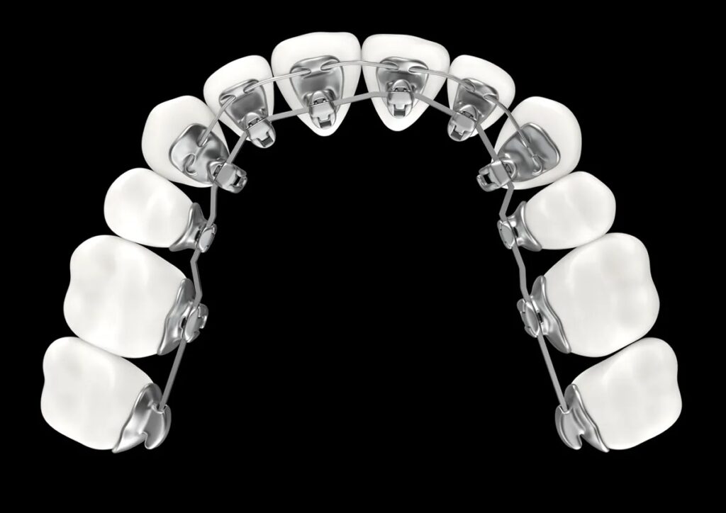 Impresora 3D de metal MLab 13 Imagen de un arco de brackets metálicos en dientes superiores, mostrando un tratamiento de ortodoncia para corregir la alineación dental.
