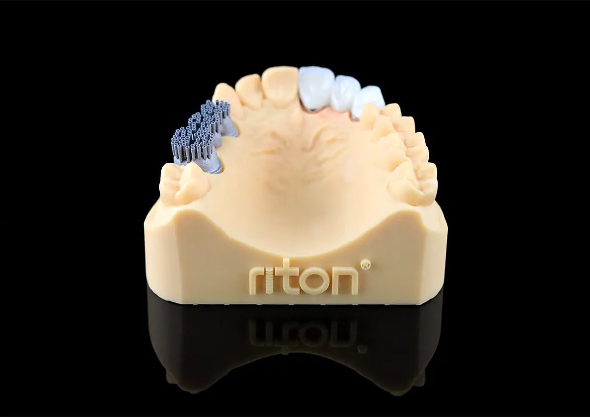 Impresora 3D de metal M-150 8 Modelo de prótesis dental con componentes metálicos y cerámicos, utilizado para planificación y fabricación de restauraciones dentales precisas.