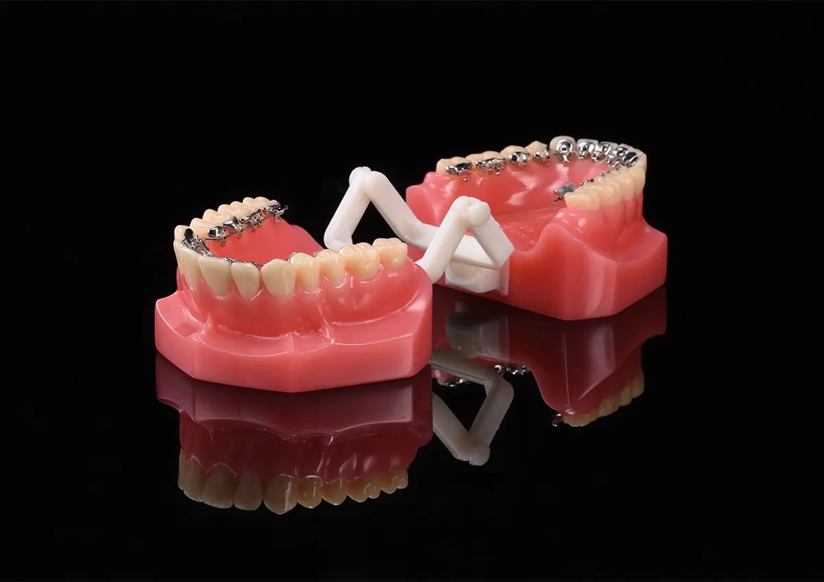 Impresora 3D de metal M-150 6 Coronas dentales con brackets y prótesis en modelo dental, mostrando diferentes tipos de restauraciones y aparatos ortodónticos para tratamientos dentales.