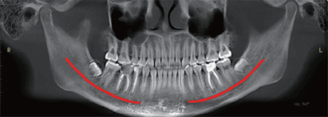 Radiografía panorámica de la mandíbula mostrando dientes y estructura ósea.