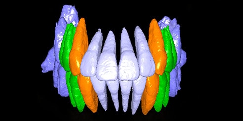 IA + Segmentación de Dientes