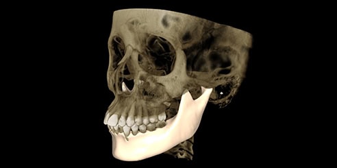 IA + Segmentación de Mandíbula