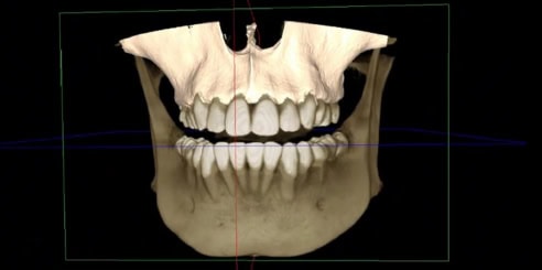 IA + Segmentación Maxilar
