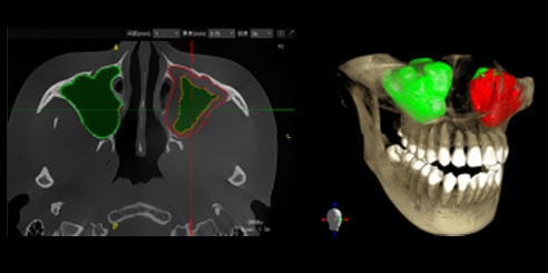 IA + Análisis del Seno Maxilar