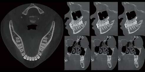 Reconstrucción Combinatoria Multiplanar (MPR)